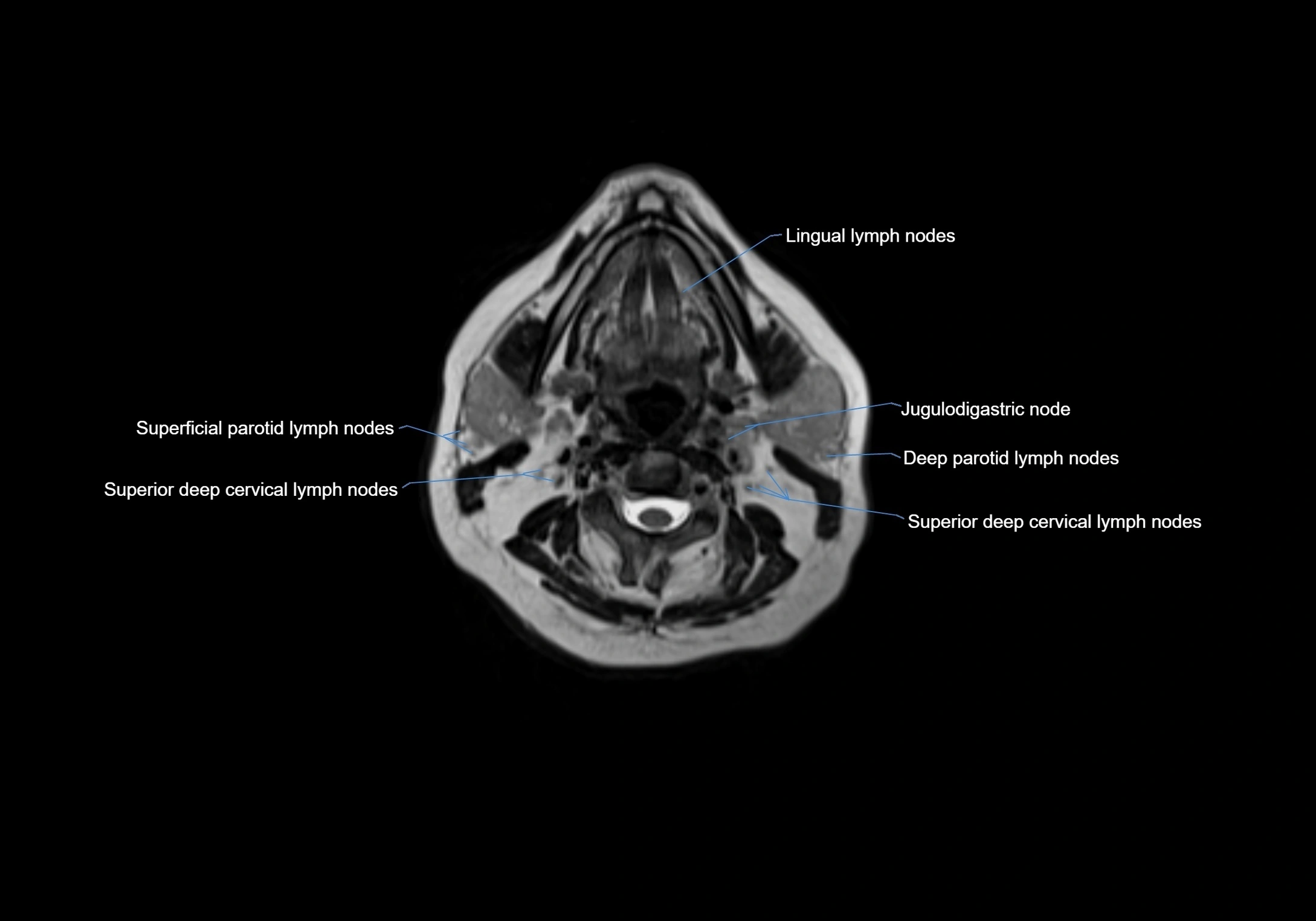 Neck axial  lymph node cross sectional MRI anatomy 3T MRI  image-img-00001-00046.webp
